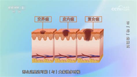 身上的痣|身上的痣能抠吗？凸起的痣和平平的痣哪个更易恶。